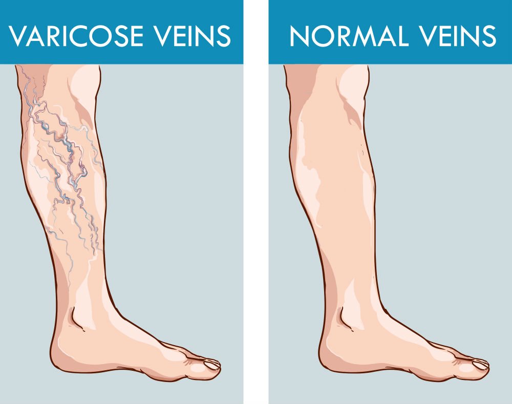 Leg Vein Issues Decoded: Causes, Symptoms, Treatments, and an Effective Home Remedy to Relieve Varicose Veins Now!