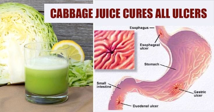 How To Make Cabbage Juice For Healing Stomach Ulcers And Open Sores