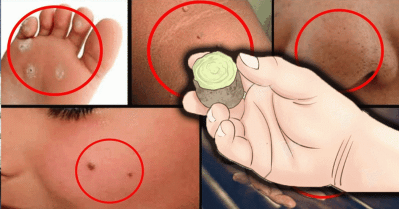 Eliminate Moles, Warts, Blackheads, Age Spots, and Skin Tags Naturally and Effectively