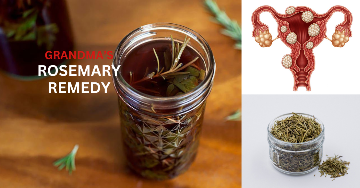 Rosemary Remedy for Uterine Myomas and Anemia Treatment