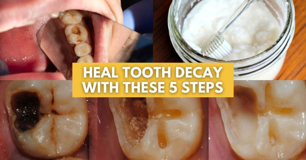 5 Proven Steps to Naturally Reverse Cavities and Heal Tooth Decay