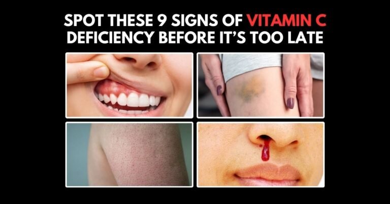 9 Early Signs You’re Low on Vitamin C Deficiency