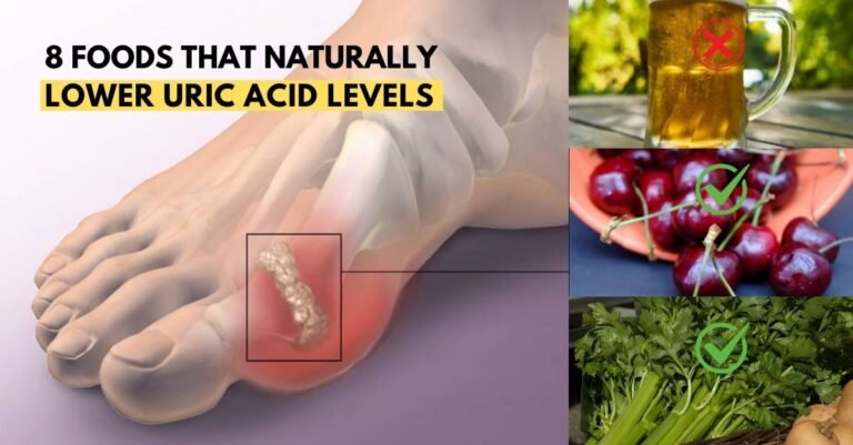 lower uric acid prevent gout naturally