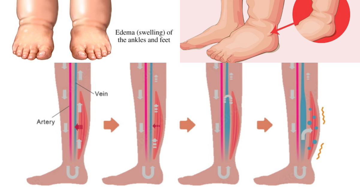 Water Retention Swollen Legs