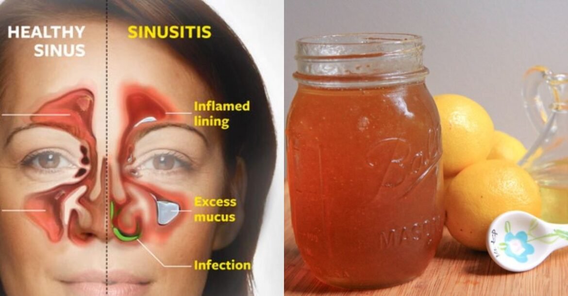 Kill Sinus Infections in Minutes With This Powerful Home Remedy