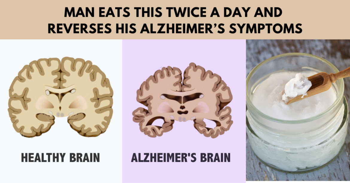 Man Slows Alzheimer’s with This Surprising Daily Habit—Doctors Are Stunned!