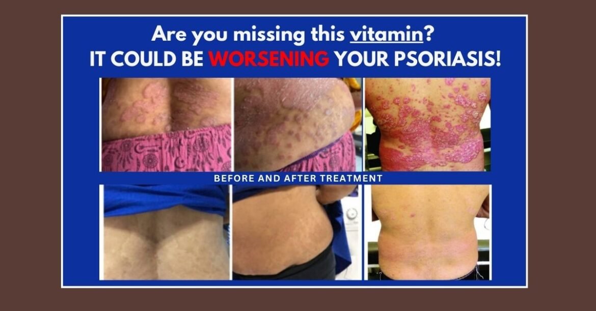 Missing This Vitamin Could Be Worsening Your Psoriasis!