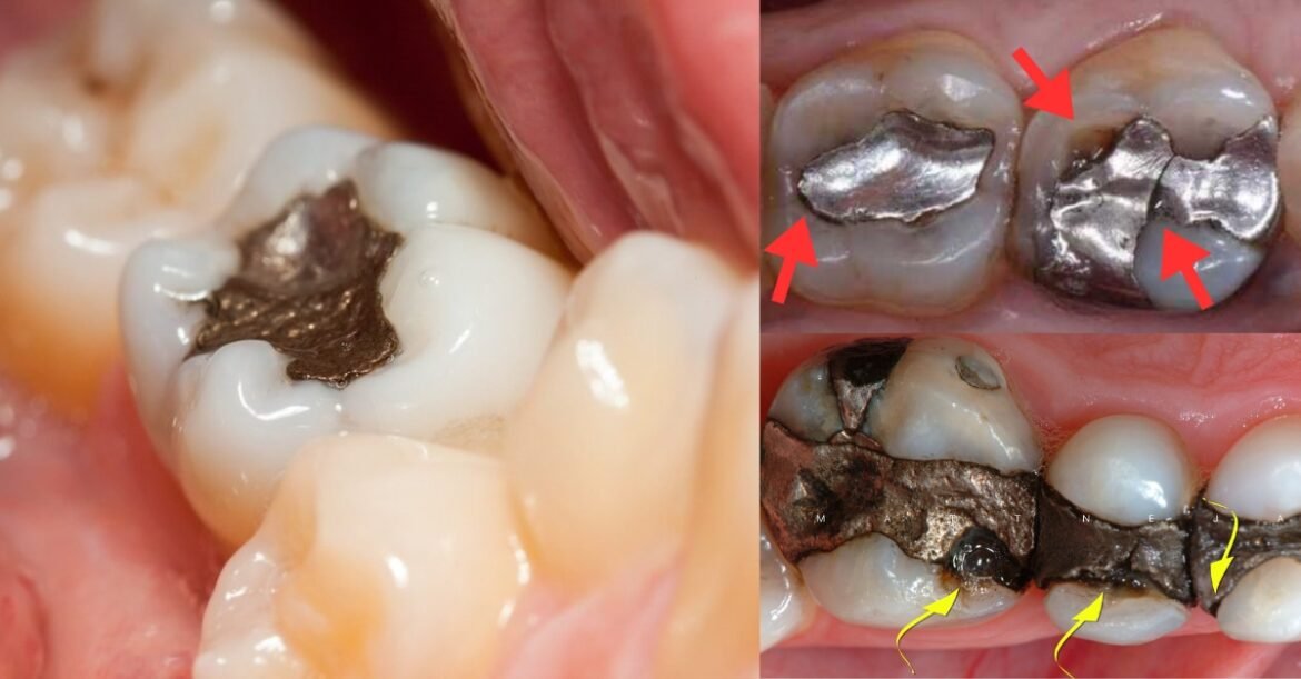 The Shocking Truth About Mercury Fillings: Hidden Health Risks Uncovered