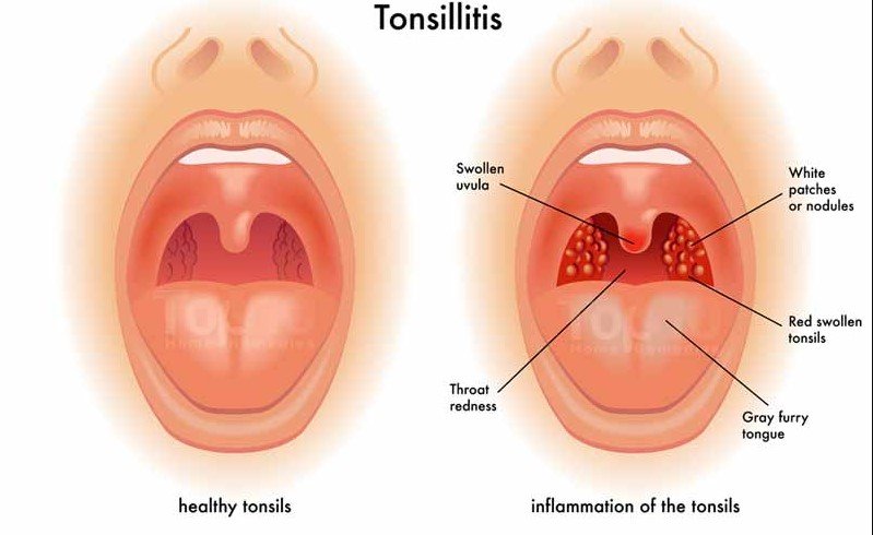 10 Natural Home Remedies to Crush Tonsillitis Fast!