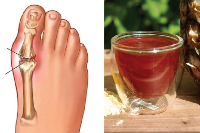 10 Natural Remedies to Crush Gout Pain Instantly