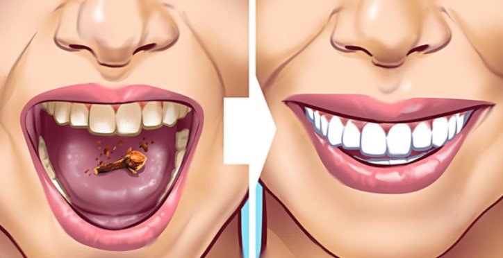 10 Natural Ways to Remove Tartar from Teeth at Home Safely