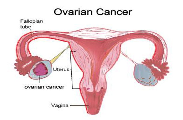 10 Shocking Ovarian Cancer Signs Women Can’t Afford to Miss