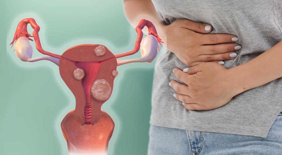 10 Shocking Uterine Fibroid Warning Signs You Can’t Ignore