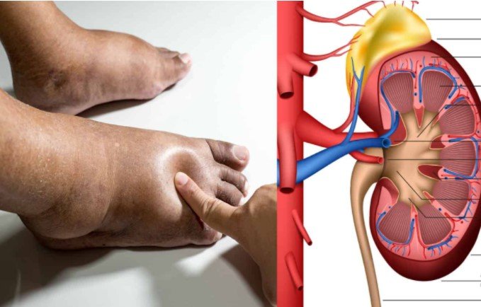 10 Silent Kidney Disease Symptoms: What Doctors Won’t Tell You