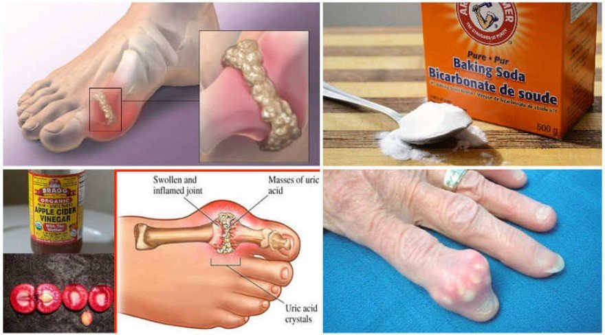 5 Secrets to Blast Away Uric Acid Crystals and Stop Gout Forever