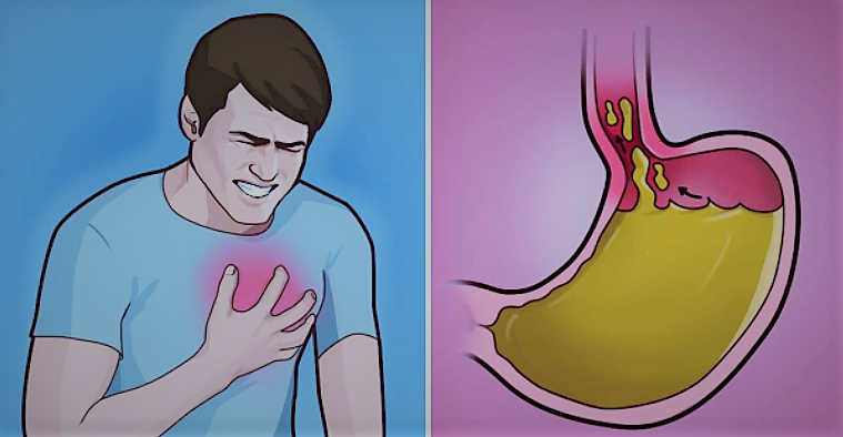 7 Instant Home Remedies to Crush Heartburn & Acid Reflux Fast