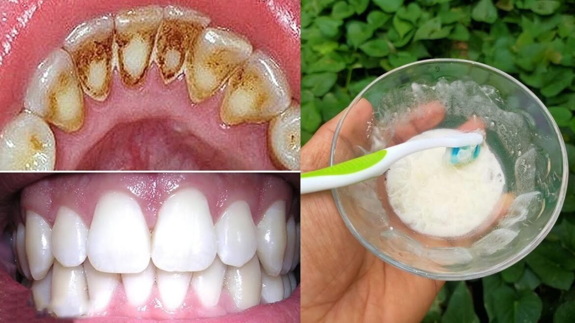 7 Natural Ways to Destroy Dental Plaque at Home Fast!