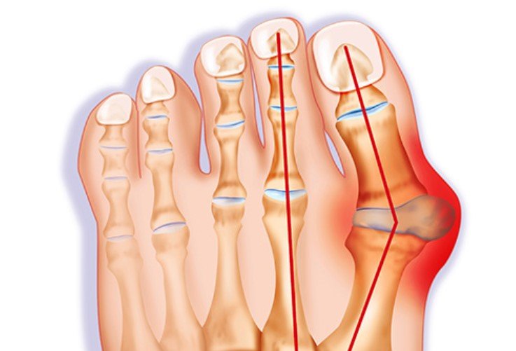 7 Powerful Bunion Treatments That Actually Work