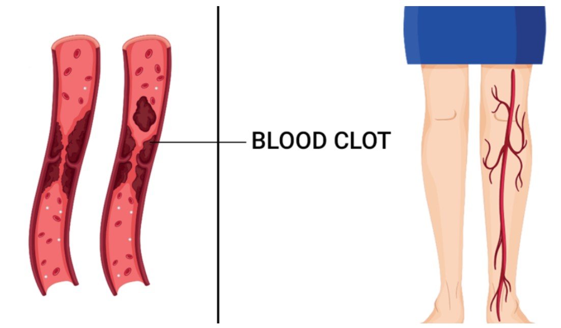 7 Shocking Blood Clot Warning Signs You Can’t Miss