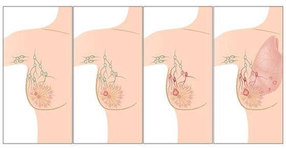 7 Shocking Breast Cancer Causes You Never Knew About