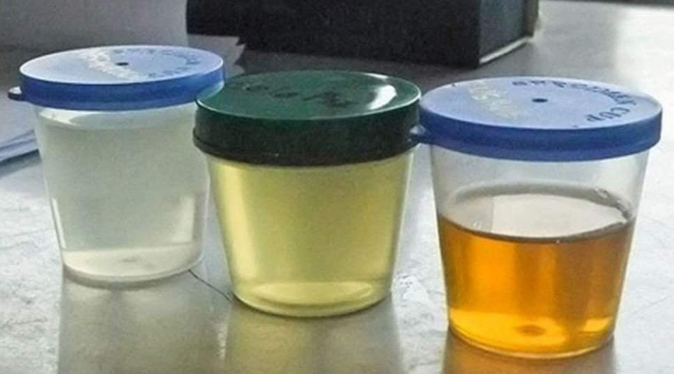 7 Shocking Urine Colors That Reveal Hidden Health Secrets