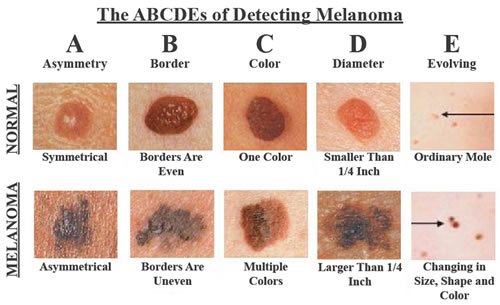 7 Skin Cancer Warning Signs That Could Save Your Life