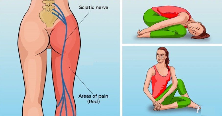 8 Simple Ways to Release Nerve Pain and Conquer Sciatica Fast