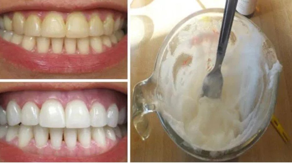 Dentist-Approved: 2 Kitchen Ingredients for Whiter Teeth