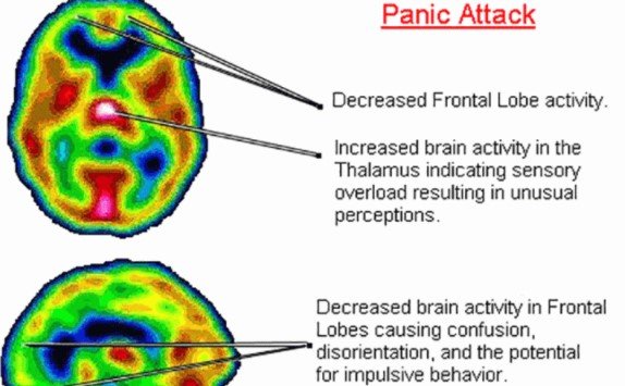 Nutrient Deficiencies Exposed: 2 Vitamins Triggering Anxiety Attacks