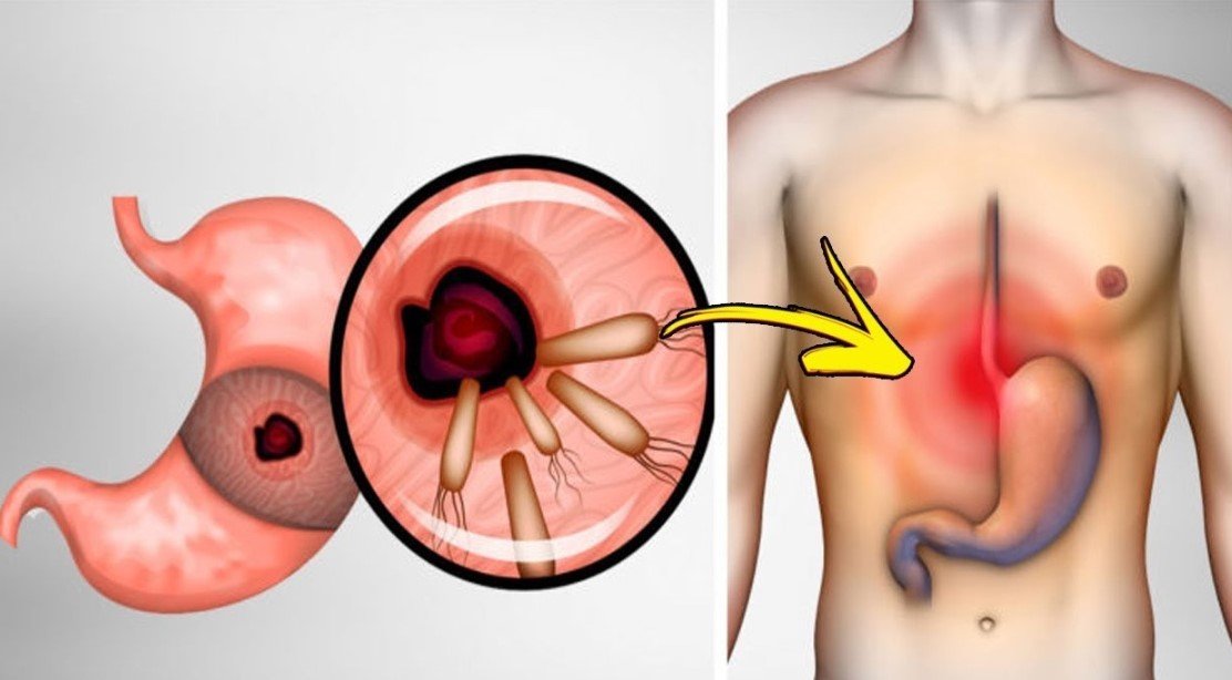 Shocking Truth: 7 Ways to Eliminate Gut Bacteria Causing Heartburn Now!