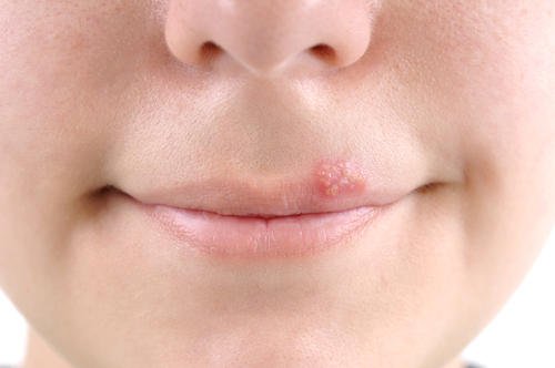 10 Powerful Natural Remedies to Heal Cold Sores Fast