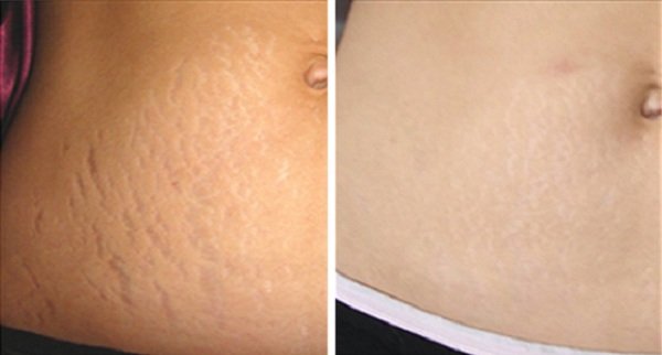 15 Mind-Blowing Natural Secrets to Banish Stretch Marks Forever