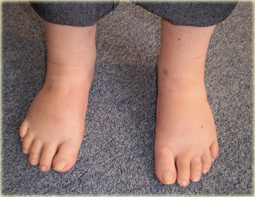 7 Shocking Natural Remedies to Instantly Reduce Ankle Swelling