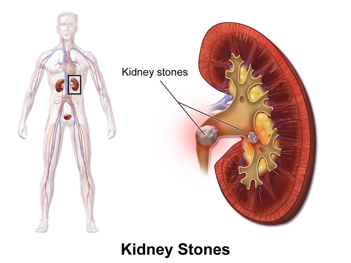 7 Shocking Natural Ways to Crush Kidney Stones Forever