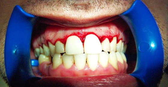 Heal Gum Disease in 7 Days: The Ultimate Natural Remedy Guide