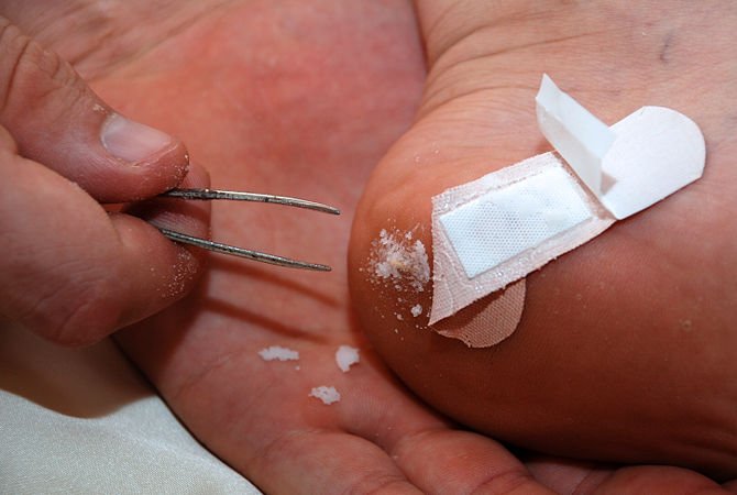 The Ultimate Hack: Painlessly Remove Splinters Using Baking Soda in Seconds!