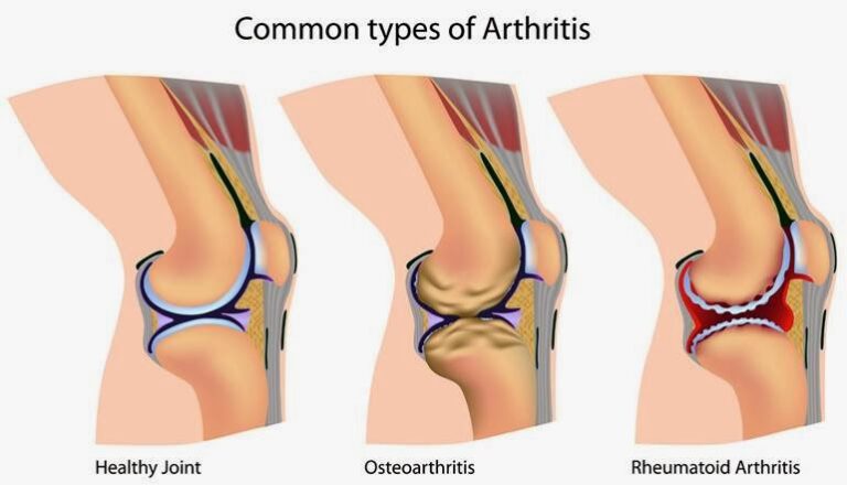 10 Powerful Home Remedies That Crush Joint Inflammation Fast!