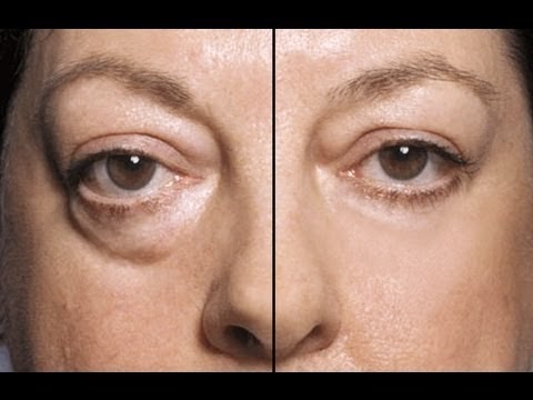 10 Shocking Home Remedies That Banish Eye Bags Overnight!