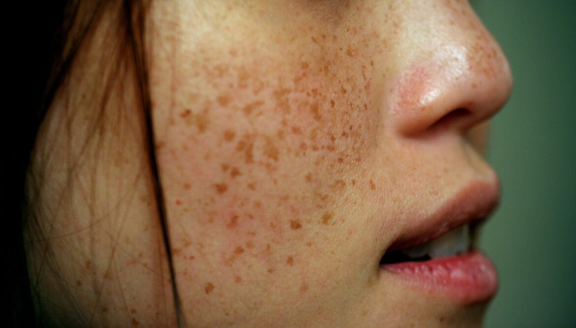 11 Mind-Blowing Natural Remedies to Banish Freckles Fast