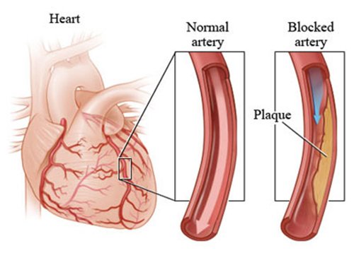 7 Heart Attack Warning Signs You Can’t Afford to Miss