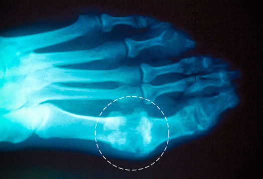 7 Proven Ways to Crush Uric Acid Crystals & Stop Gout Pain Fast!