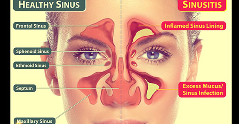 9 Natural Sinus Infection Cures Doctors Don’t Want You to Know