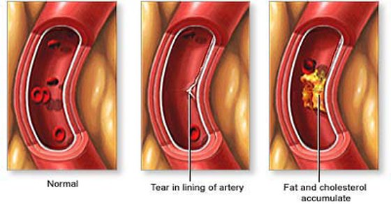 9 Powerful Foods That Naturally Unclog Your Arteries Fast