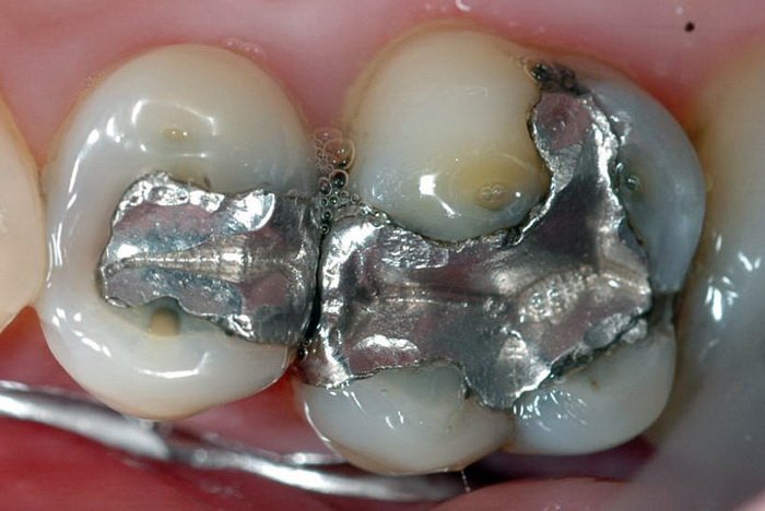 Dental Amalgam Fillings: The Silent Health Threat Exposed!