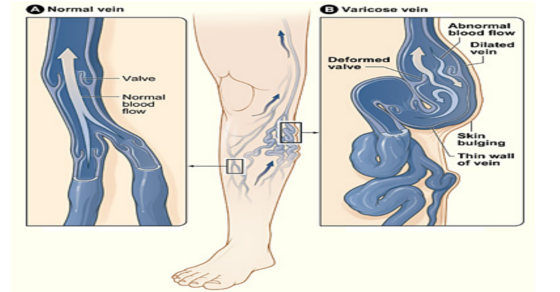 Heal Varicose Veins: 3 Shocking Natural Remedies Revealed!