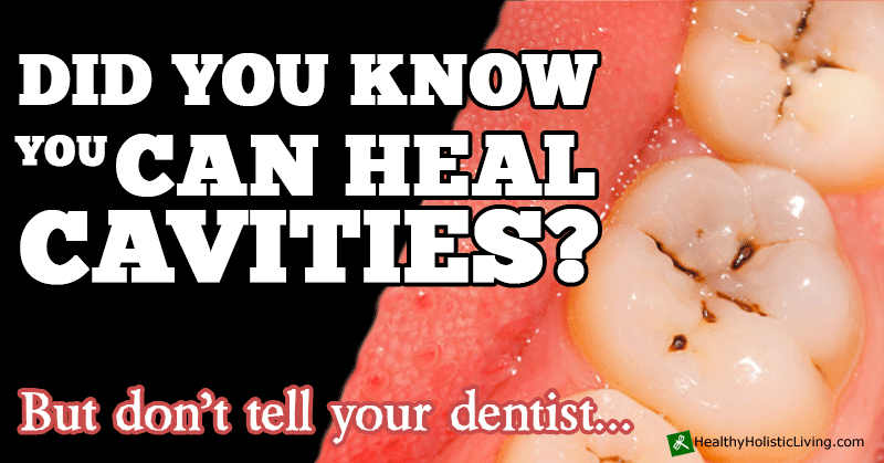 Miracle Mouth Hack: 5 Ways to Naturally Heal Cavities Forever