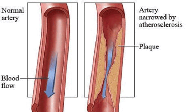 The Miracle Fruit That Instantly Cleans Your Arteries Naturally