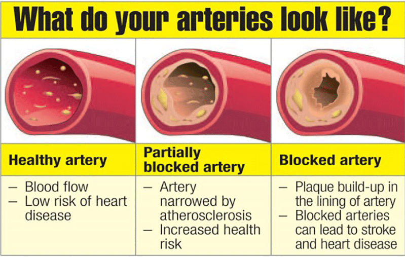 Unclog Your Arteries Naturally: 8 Powerful Foods Revealed!