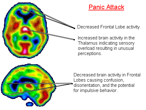 Hidden Nutrient Deficiency: 5 Shocking Ways B6 and Iron Trigger Panic Attacks